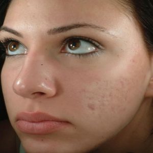acne-scars-after-popping-control-for-endometriosis-birth-key