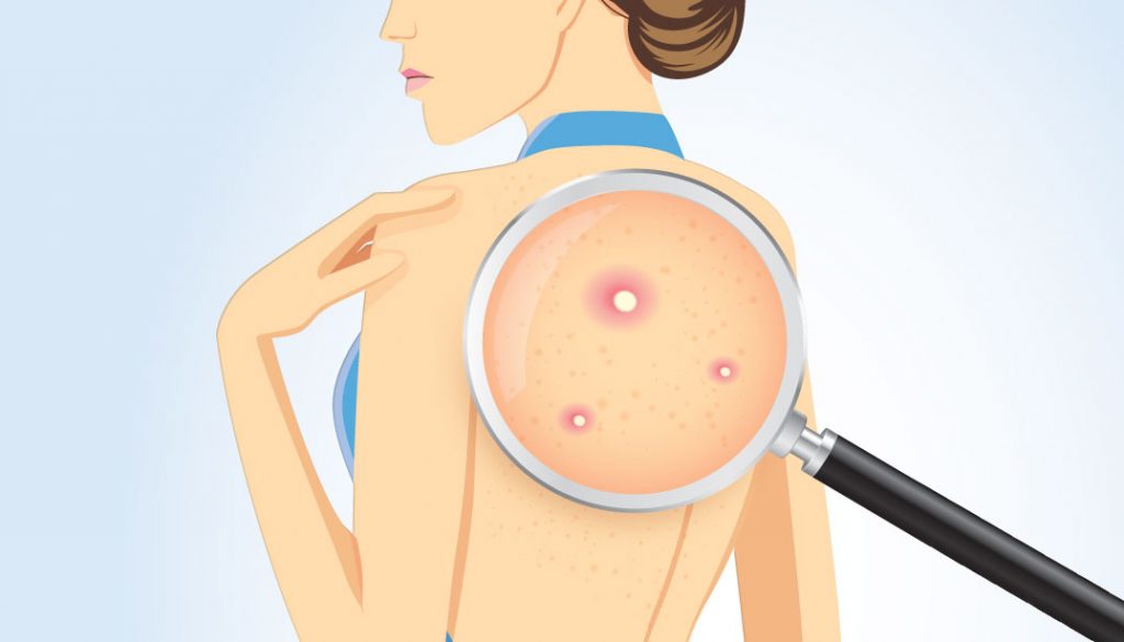 treatments-for-back-acne-1076x615
